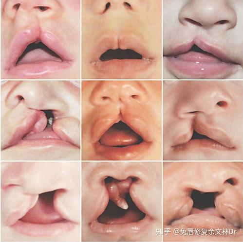 兔唇的图片,探寻面部畸形的成因与治疗